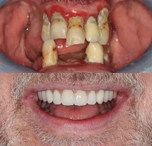 broken, missing and unhealthy teeth before smile in a day treatment at Total Dental Care